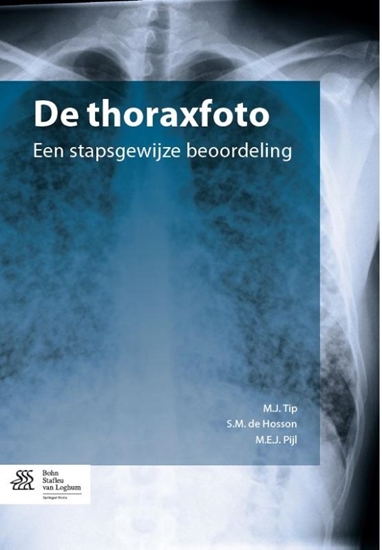 Afbeelding van De thoraxfoto