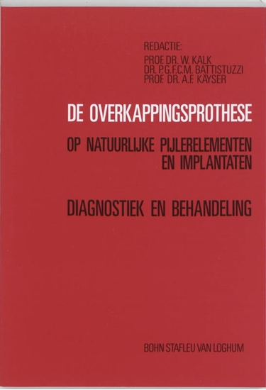 Afbeelding van De overkappingsprothese op natuurlijke pijlerelementen en implantaten