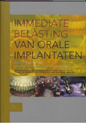 Afbeeldingen van Immediate belasting van orale implantaten