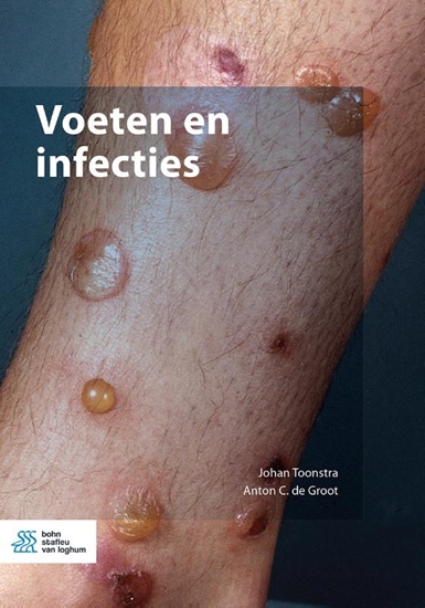 Afbeelding van Voeten en infecties