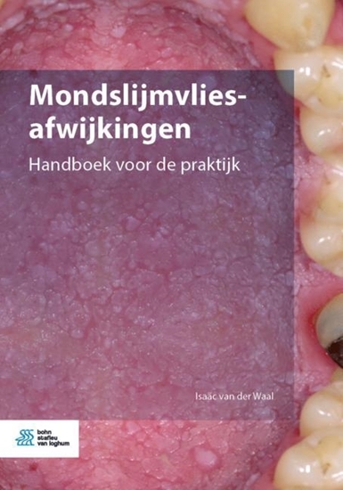 Afbeelding van Mondslijmvliesafwijkingen