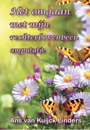 Afbeeldingen van het omgaan met mijn rechter bovenbeen amputatie