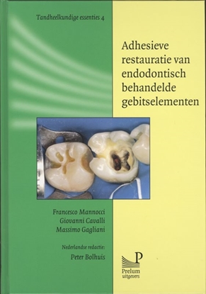 Afbeeldingen van Tandheelkundige essenties Adhesieve restauratie van endodontisch behandelde gebitselementen