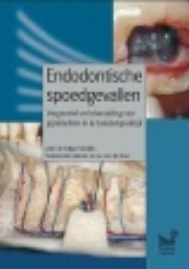 Afbeelding van Endodontische spoedgevallen