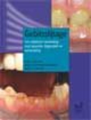 Afbeeldingen van Gebitsslijtage