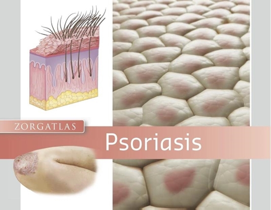 Afbeelding van Zorgatlas Psoriasis