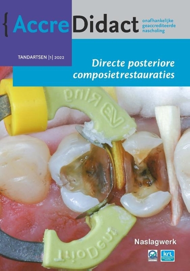Afbeelding van AccreDidact Directe posteriore composietrestauraties