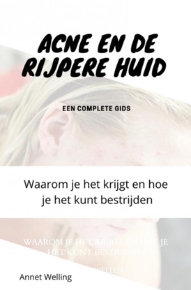 Afbeeldingen van Acne bij volwassenen