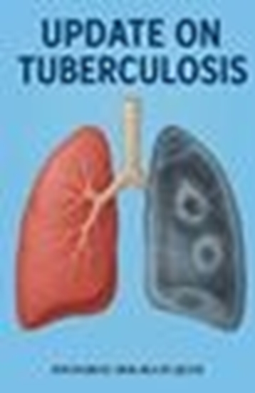 Afbeelding van Update on tuberculosis
