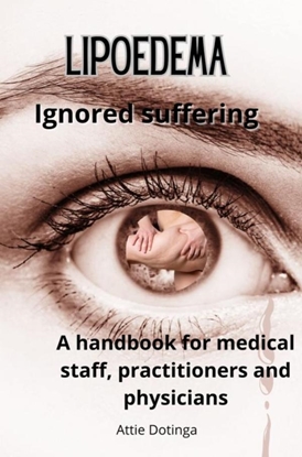 Afbeeldingen van Lipoedema