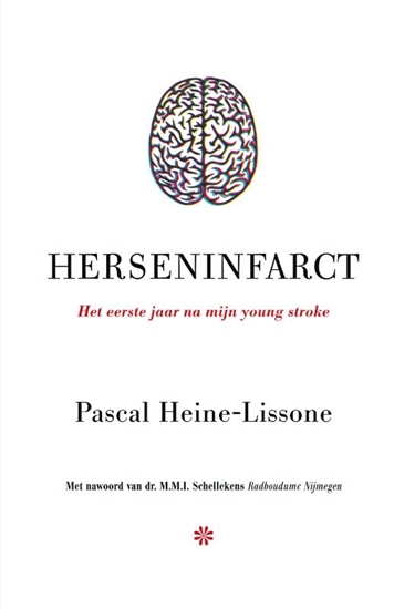 Afbeelding van Herseninfarct